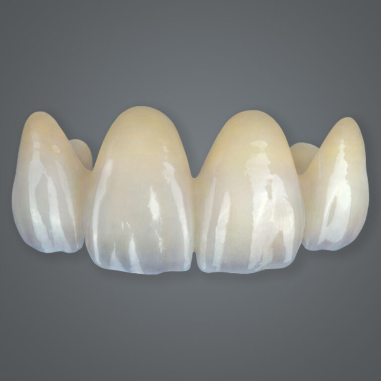 Esthetic Multilayer Zirconia