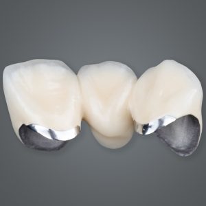 PFM – Porcelain Fused Metal Dental Crown
